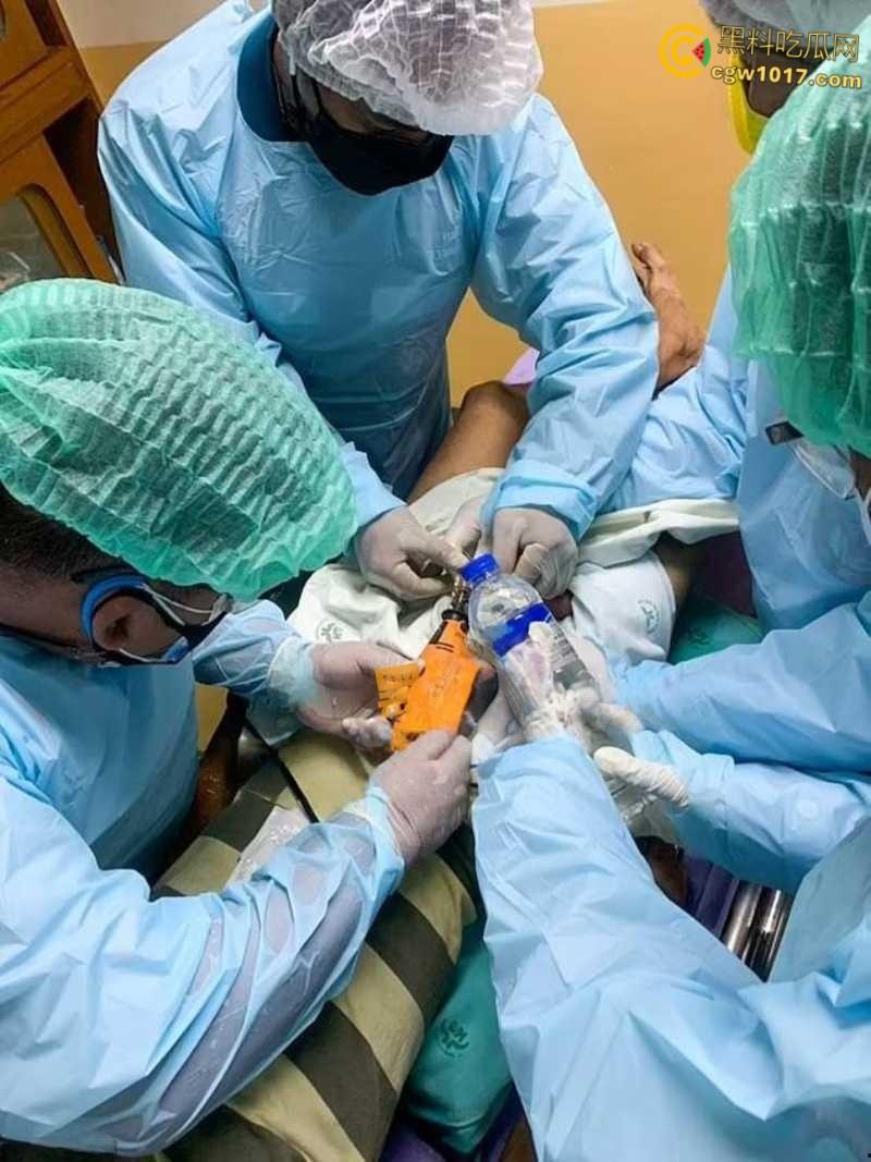 小说照进现实，男子追求刺激螺母自慰，勃起后被螺母卡住，消防人员和医生同时出动，解救被困阴茎 ！-3