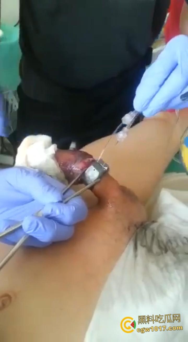 小说照进现实，男子追求刺激螺母自慰，勃起后被螺母卡住，消防人员和医生同时出动，解救被困阴茎 ！-5